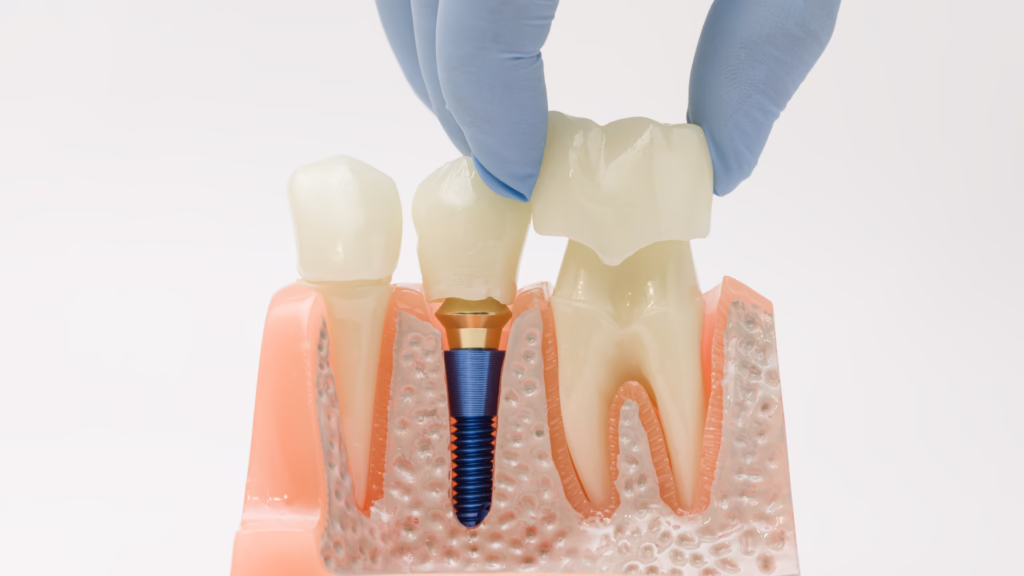 What Is a Dental Crown?