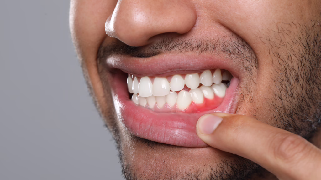 How to Prevent Gingivitis